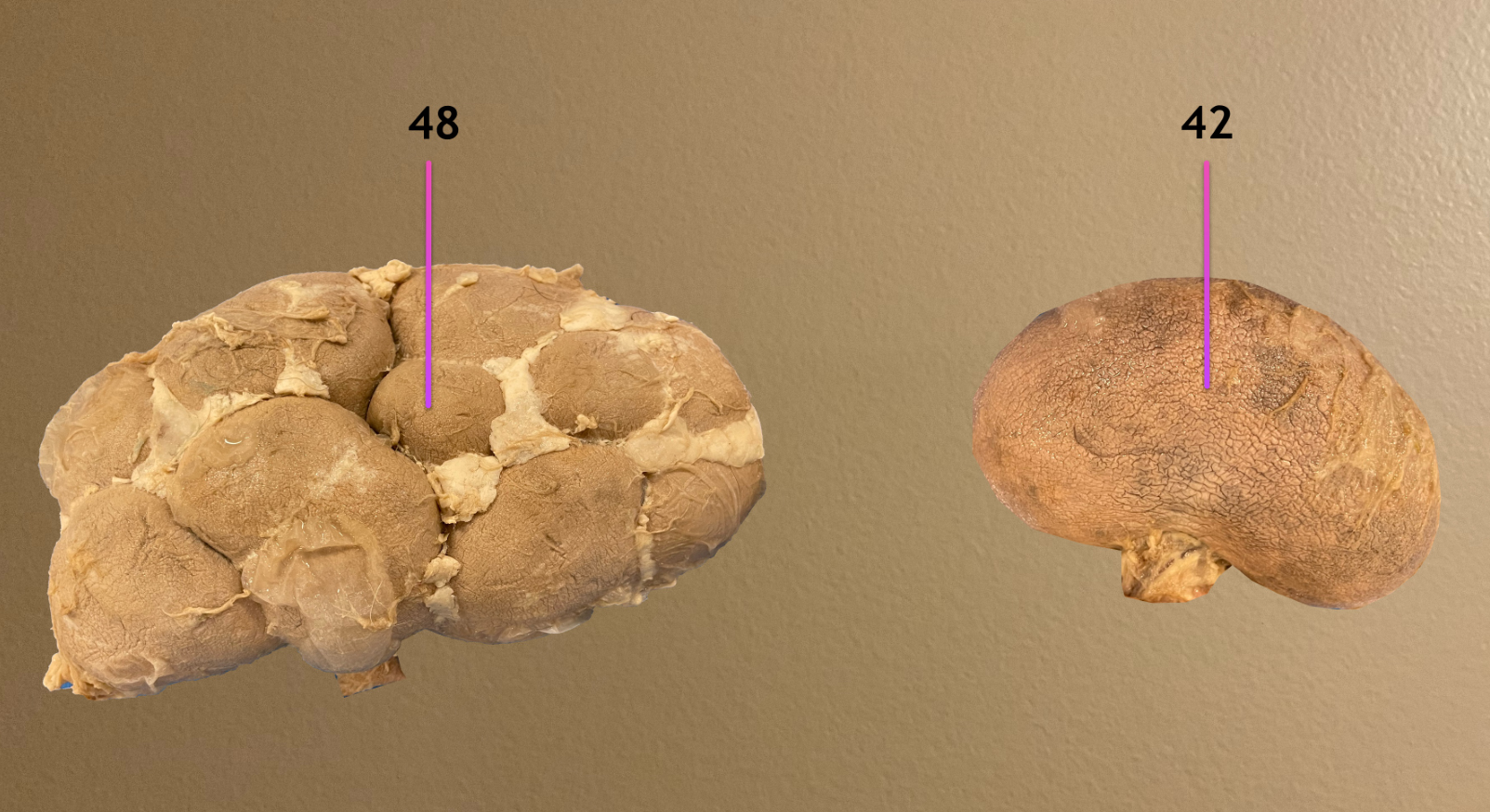 <p>label the types of kidney</p>