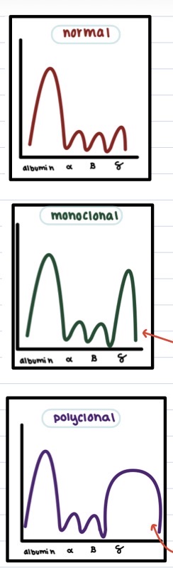 <ul><li><p>normal:</p><ul><li><p>large albumin peak</p></li><li><p>all other peaks tgt look small/flat/plateau-shaped</p></li></ul></li><li><p>monoclonal gammopathy:</p><ul><li><p>large albumin peak</p></li><li><p>tall, narrow, gamma globulin peak</p></li><li><p>indicative of cancer (esp lymphoma) bc many of 1 specific Ab present usually d/t tumor cell overproducing that Ab</p></li></ul></li><li><p>polyclonal gammopathy:</p><ul><li><p>large albumin peak</p></li><li><p>tall, wide, gamma globulin peak</p></li><li><p>indicative of chronic infection bc many diff. Ab present d/t persistent Ag presentation + B cell activation</p></li></ul></li></ul><p></p>