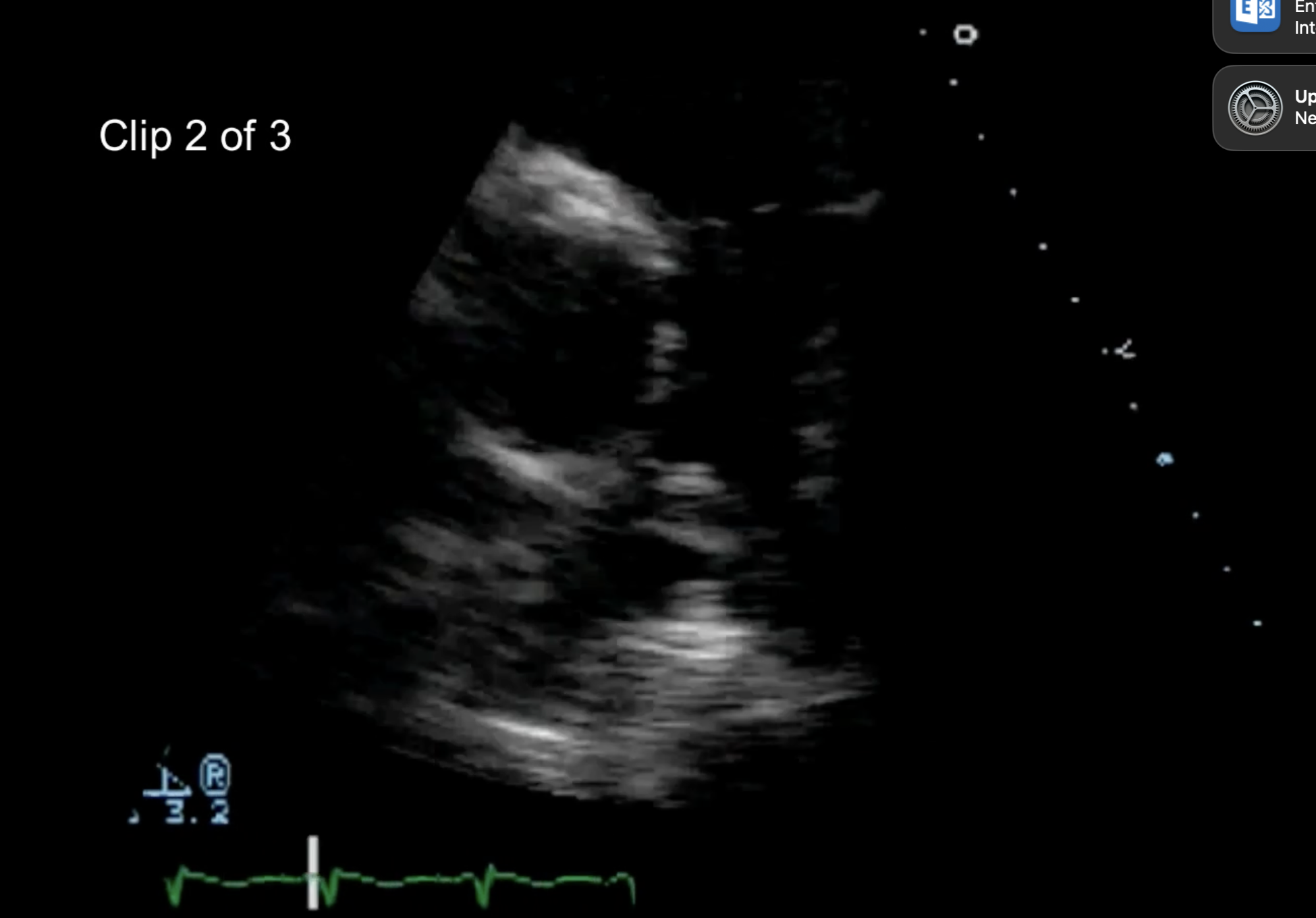 <p>Terrible image quality but what can be seen in the PA bifucraction?</p>