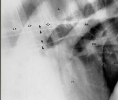 <p>What is subcutaneous emphysema a sequelae to?</p>