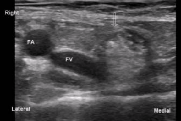 <ul><li><p><span style="background-color: transparent;">Protrusion of transversalis fascia - medial to CFV</span></p></li><li><p><span style="background-color: transparent;">More common in women (especially w/ pregnancy)</span></p></li><li><p><span style="background-color: transparent;">High risk of incarceration and strangulation</span></p><ul><li><p><span style="background-color: transparent;">Because they are long w/ narrow neck</span></p></li></ul></li></ul><p></p>
