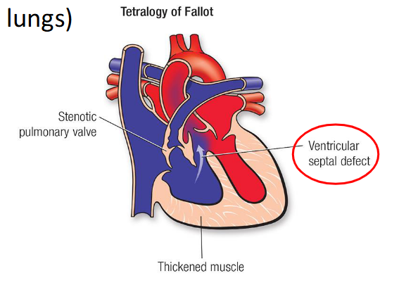 <ul><li><p class="Paragraph SCXO94458440 BCX0" style="text-align: left;"><span style="background-color: inherit; line-height: 20.7px; color: windowtext;">Where blood doesn’t physically go through the lungs, due to structural defect in the heart (abnormal blood flow from heart to lungs </span><span style="line-height: 20.7px; color: windowtext;"> </span></p></li><li><p class="Paragraph SCXO94458440 BCX0" style="text-align: left;"><span style="background-color: inherit; line-height: 20.7px; color: windowtext;">The pulmonary circulation is partially bypassed due to a physical short circuit of blood flow through the heart. Blood flow to the alveoli is therefore reduced </span><span style="line-height: 20.7px; color: windowtext;"> </span></p></li></ul><p></p>