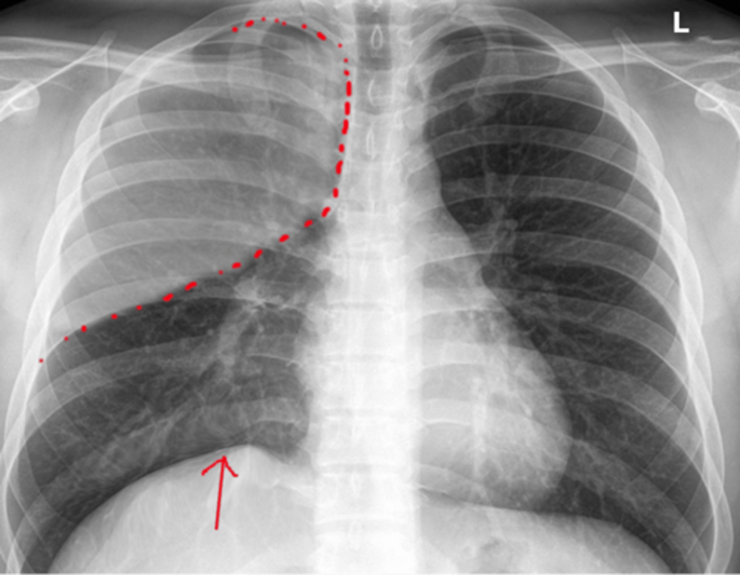 <p>-condition involving a collapsed lung</p><p>-collapsed portion appears lighter (more "radiodense") sense there is less air in the lung</p>