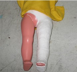 <p><span>hip and femur affections</span></p>