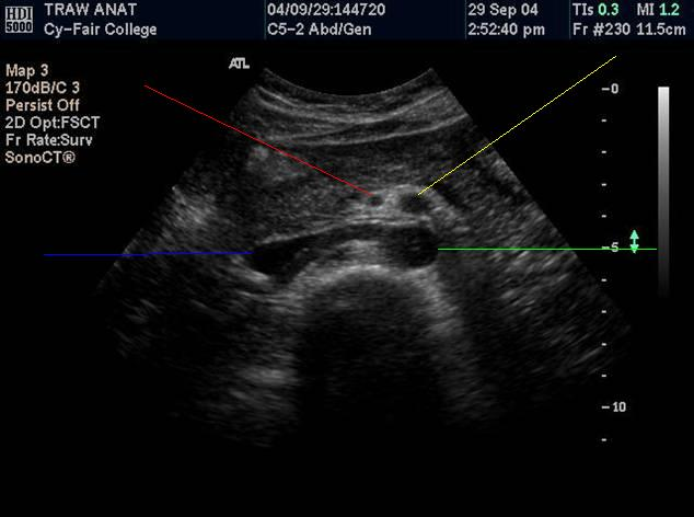 <p><strong>The green line points to the</strong></p><p>Aorta</p><p>SMA</p><p>Proper hepatic artery</p><p>Portal splenic confluence</p>