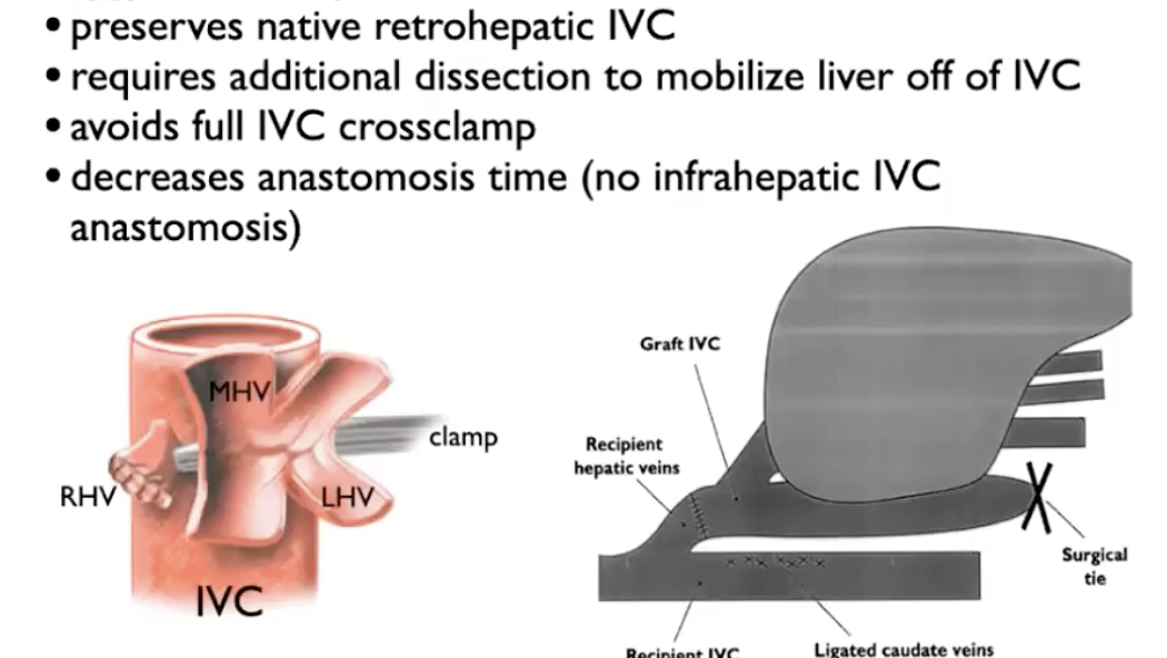 <ul><li><p>Situation where the retorhepatic inferior vena cava is preserved in recipient rather than removed </p></li><li><p>requires additional disection to mobilize liver off inferior vena cava </p></li></ul><p></p>