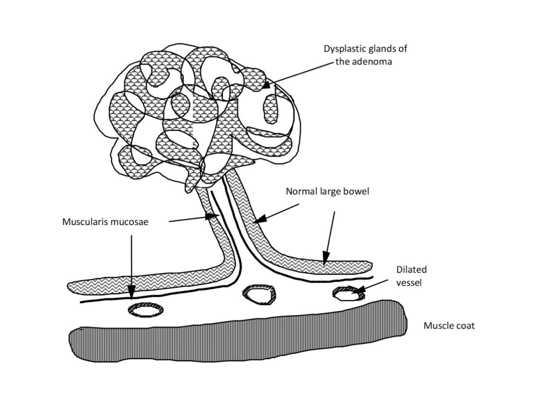 <p>anatomy of a benign polypoid adenoma</p>