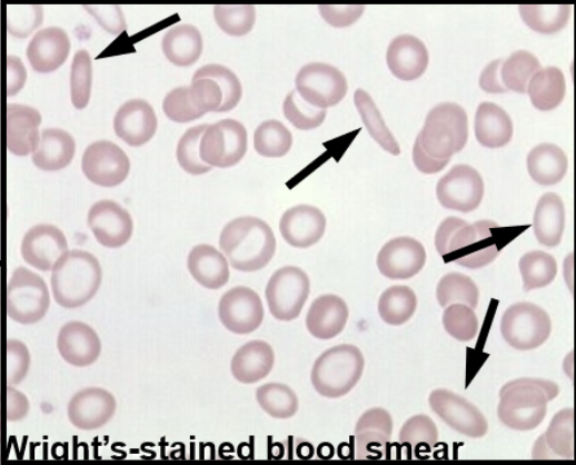 <p>Iron Deficiency Anemia</p>