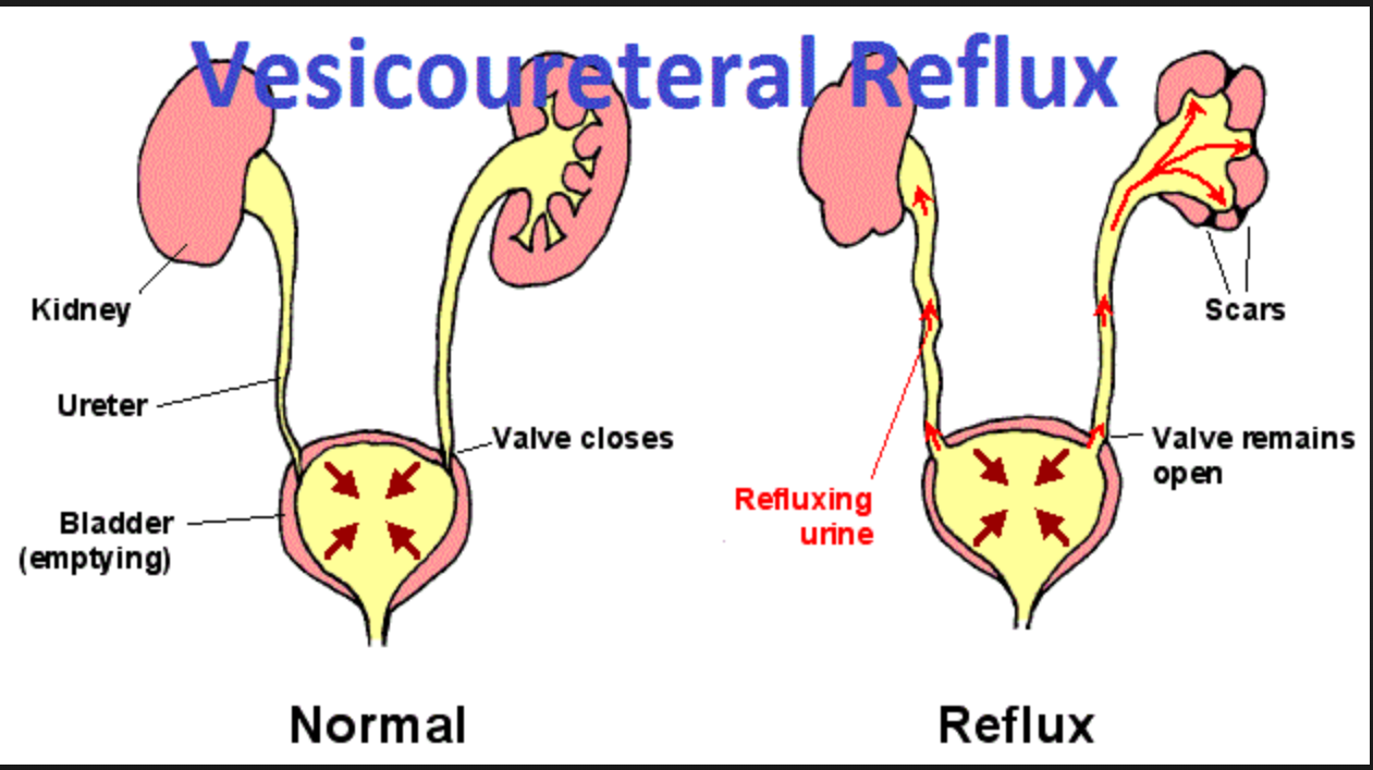 <p>vesicouretral reflux (VUR)</p>