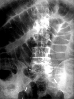 <p>¿Cuál de las siguientes patologías se muestra radiolúcida en la imagen?</p>