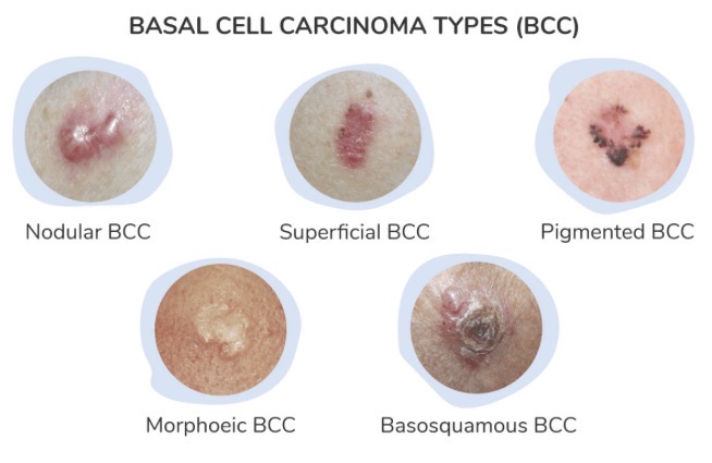 <ul><li><p>slow growing</p></li><li><p>Most common type of skin cancer</p></li><li><p>Red Ulcer, pearly borders</p></li></ul><p></p>
