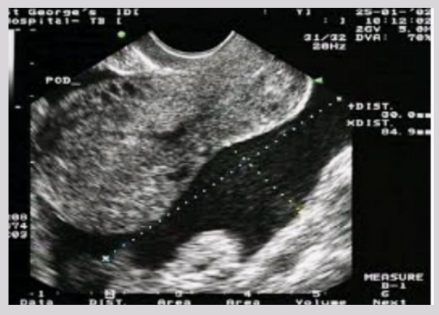 <p><span style="background-color: transparent;">Ectopic pregnancy not seen due to amount of blood and clot</span></p>