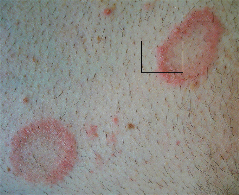 <p>Circular skin lesion configuration.</p>