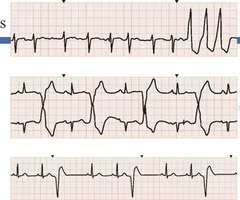<p><span>triplet</span>: three consecutive premature ventricular contractions (extra heartbeats originating in the lower chambers) on an ECG, classfied as VTACH</p><p><span>bigeminy:</span> a normal heartbeat is consistently followed by a Premature Ventricular Contraction (PVC), a pattern of two beats close together, followed by a slight pause. It often feels like a skipped beat, flip-flop, or pounding in the chest</p><p><span>trigeminy</span>: a heart rhythm pattern where a premature ventricular contraction (PVC) occurs every third heartbeat, creating a repeating sequence of two normal beats followed by one early, extra beat</p>