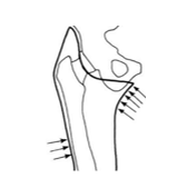 <p>Px too short </p><p>Femur not stabilized laterally - could be that the lateral wall was not shaped, wide M-L dimension, insufficient socket adduction </p><p>Pain - ramus pressure or distal-lateral femur pressure </p>