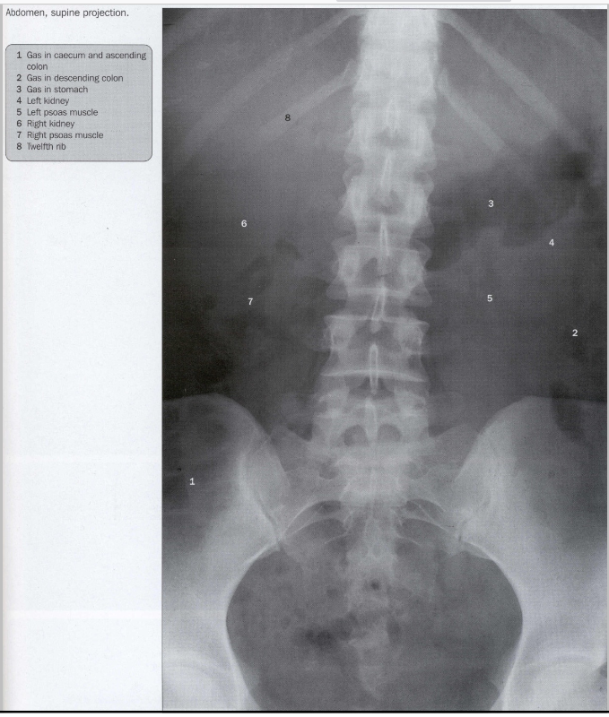 <ul><li><p>1.1: colon ascendens</p></li></ul><ul><li><p>1.2: caecum</p></li><li><p>2: colon descendens</p></li><li><p>A: curvatura minor</p></li><li><p>B: curvatura major</p></li></ul><p></p>