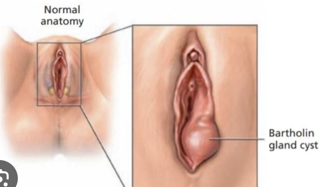 <p>inflammation of one or both Bartholin gland ducts.</p>