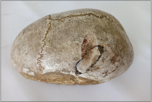 <p>Questions</p><ol><li><p>What is the specimen being examined?</p></li><li><p>What are the types and specific descriptive features of the two injuries on the skull?</p></li><li><p>What type of causative instrument and angle of impact produce these injuries?</p></li><li><p>How is the time of death estimated?</p></li><li><p>What are the possible causes of death?</p></li><li><p>What is the final diagnosis for this specimen?</p></li></ol><div data-type="horizontalRule"><hr></div><p></p><p></p>