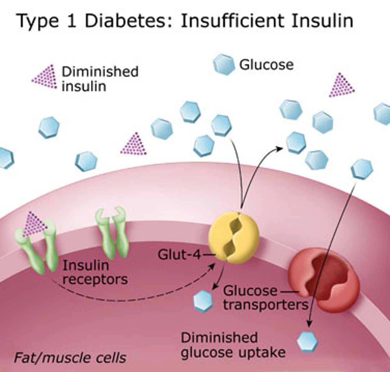 <p>Early Onset Diabetes</p><p>CAUSED BY: autoimmune destruction of ß cells</p><p>OCCURRENCE: Usually before 20 but can occur in childhood, adolescence, or adulthood.</p><p>RESULTS IN: little/no insulin production</p><p>TREATMENTS: Regular insulin injection, monitoring of blood glucose, lifestyle adjustments</p>