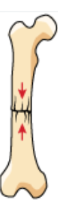 <p>when the broken ends of a bone are driven into each other without displacement </p>