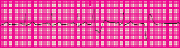<p>Which rhythm is this?</p>