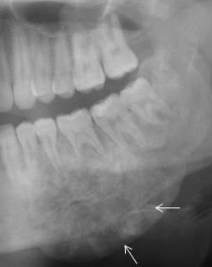 <p>tapered roots seen in osteosarcoma </p>