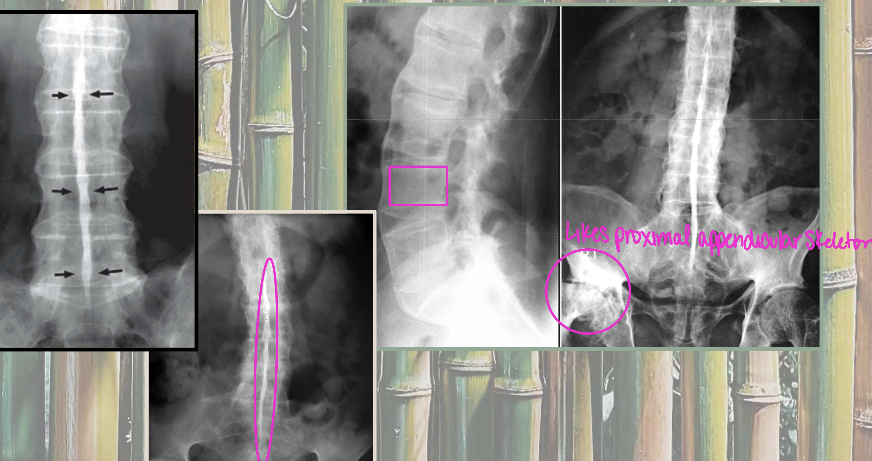 <p>What finding of AS is found in this image</p>