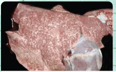 <p>In multifocal neonatal atelectasis, what specific visual layout is formed by the contrasting lung zones? Describe which zones are lighter and which are darker.</p>