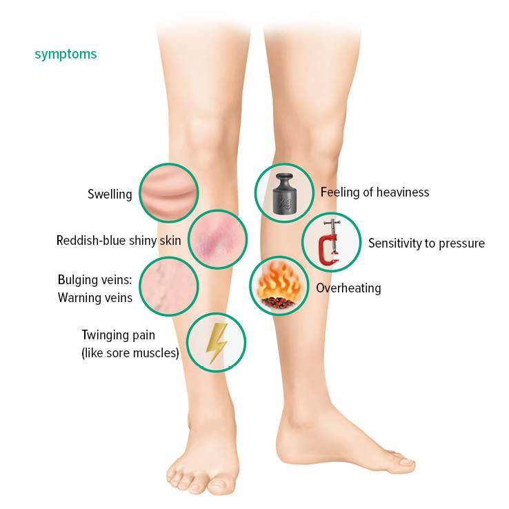 <p>clinical findings with DVT</p>