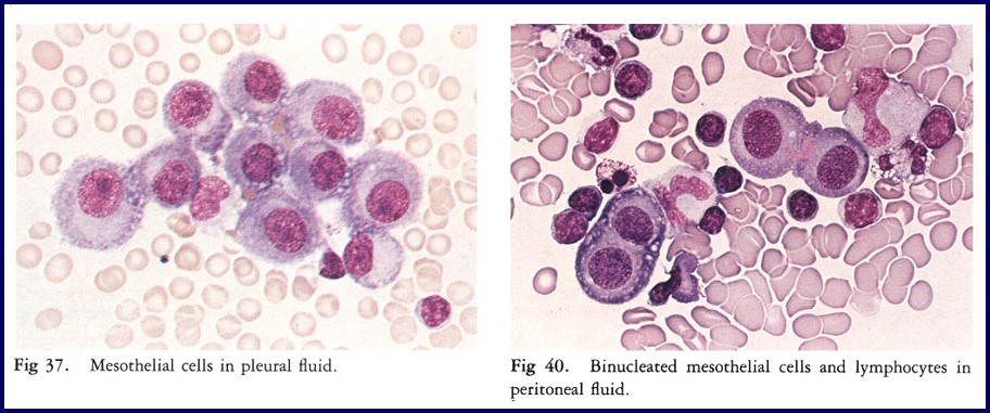 <ul><li><p>Appear as sheets or clusters of cells</p></li><li><p>12-30 μm with “fried egg” appearance</p></li><li><p>May be bi- or multinucleate (>20 nuclei/cell) with small vacuoles</p></li></ul><p></p>