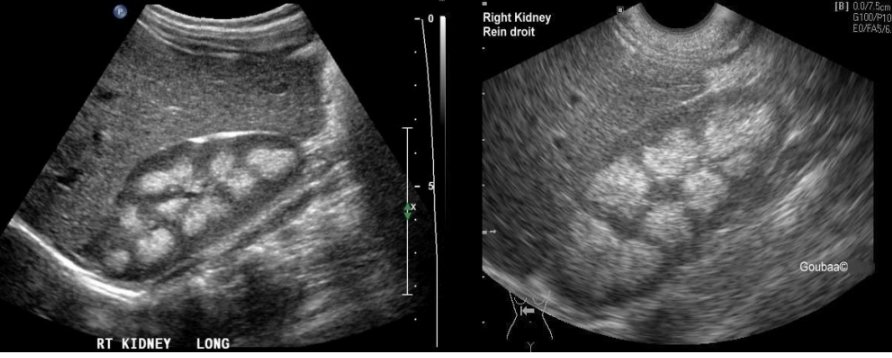 <p>Birth defect</p><p>Tiny cysts formed in the tubules within the medulla. This can cause hematuria, stones and UTI’s.</p>