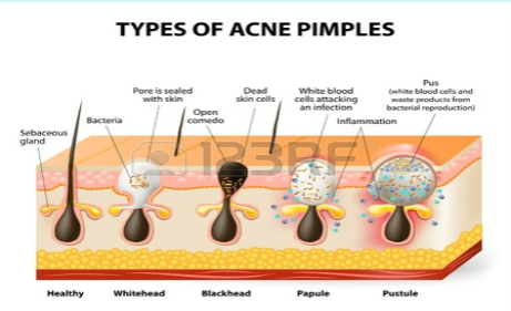 <ul><li><p>Simple (branched) alveolar multicellular exocrine glands</p></li><li><p>Found all over body, except on palms and soles</p></li><li><p>Secrete oily substance (sebum) into hair follicles and via pores to surface of skin</p></li><li><p>Sebum softens and lubricates hair and skin</p></li><li><p>Secrete via HOLOCRINE mode of secretion</p></li><li><p>Whiteheads → sebum accumulated in ducts of sebaceous glands</p></li><li><p>Blackheads → popped whiteheads that result in oxidation and darkening</p></li><li><p>Acne → inflammation of sebaceous glands caused by bacteria</p></li></ul><p></p>