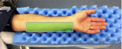 <p>stimulation of ulnar nerve results in contraction of adductor pollicus; distal electrode placed over proximal flexor crease of the wrist & proximal electrode placed over flexor carpi tendon </p><p>đź’ˇadductor pollicus is among the last muscles to recover from non-depolarizing NMBDs</p>