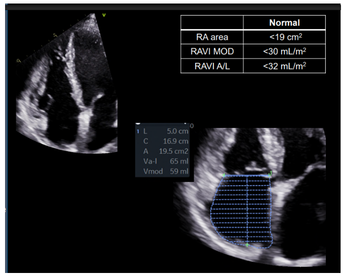 <p>RA area/volume</p><p></p><p>- trace the RA cavity from medial to posterior annulus excluding RAA</p><p>- make sure RA length is centered</p><p></p><p><strong>timing</strong></p><p>- ventricular end-systole: one frame immediately preceding TV opening or when RA is at its largest</p>