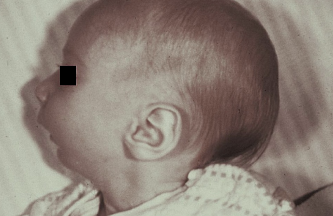 <p>cleft palate, mandibular micrognathia, glossoptosis (post. motion of tongue)</p>