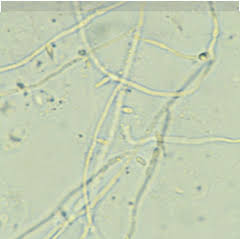 <p>Vaginal infection due to candida albicans, which is not considered to be an STI</p><p>-RF: immunocompromised, obesity, pregnancy, OCP use </p><p>-Presentation: vulvar itching, burning, dysuria, dyspareunia, and vaginal discharge that is “thick, adherent, cottage cheese discharge” </p><p>-Dx: pseudohyphae on KOH prep </p><p>-Tx: topical miconazole/clotrimazole/terconazole or PO fluconazole </p>