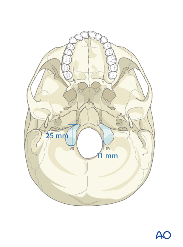 <p>Occipital condyle</p>