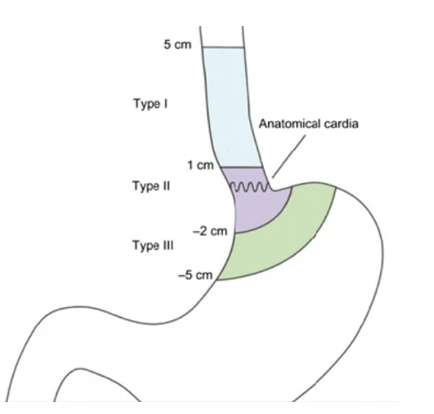 <p>Sievert 1 : 5 à 1cm en dessus de la JOG</p><p>Sievert 2 : 1 à -2 (versant estomac) cm de la JOG</p><p>Sievert 3 : -2 à -5 de la JOG </p>