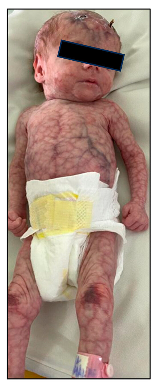 <ol><li><p><span style="color: rgb(228, 76, 76);"><strong>mottled </strong></span>skin</p></li><li><p><span style="color: rgb(113, 80, 247);"><strong>excessive cries</strong></span></p></li><li><p><span style="color: rgb(54, 190, 100);"><strong>hyperactive </strong></span>reflexes</p></li><li><p><span style="color: rgb(211, 24, 201);"><strong>hypertonia</strong></span></p></li><li><p><span style="color: rgb(179, 150, 36);"><strong>seizures</strong></span></p></li><li><p><span style="color: rgb(113, 133, 244);"><strong>feeding issues</strong></span></p></li></ol><p></p>