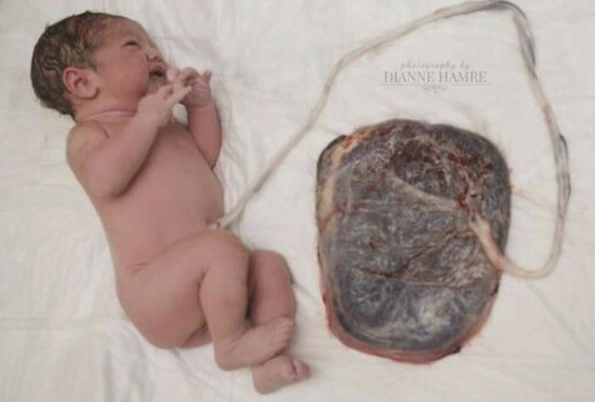 <ul><li><p>babies are born with 2/3 of their blood</p></li><li><p>1/3 of their blood is still in placenta</p></li><li><p>umbilical cord clamping/cutting is not done immediately after birth</p><ul><li><p>wait 30-60 seconds after birth to allow more blood to transfer from placenta to baby</p></li></ul></li><li><p>benefits:</p><ul><li><p>babies have higher hemoglobin</p></li><li><p>higher iron</p></li><li><p>better transition to breathing outside </p></li></ul></li></ul><p></p><p>** now a widely recommended as standard care</p>