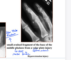 <p>Just a small Avulsion fracture and not a mallet finger because a mallet finger is on the dorsal surface and this Avulsion fracture is on the volar (palmar) surface</p>