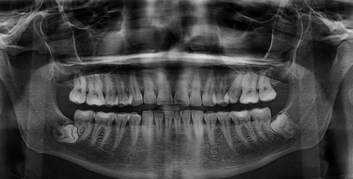 <p>obstructed by a physical barrier, lack of eruptive force = embedded, rarely occurs in deciduous teeth </p>