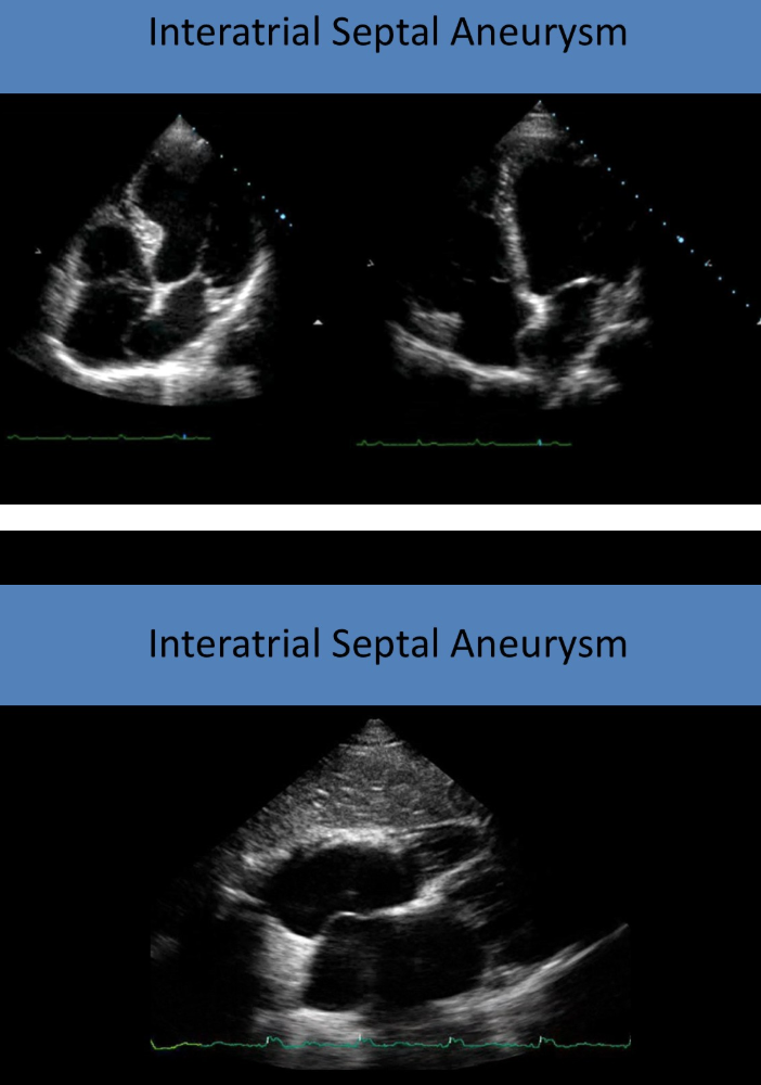 <p>interatrial septal aneurysms </p><ul><li><p>defect of septumprimum layer </p></li></ul><p></p>