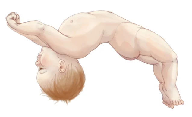 <p><strong>Opisthotonos</strong> appearance? What is it the result of? (Abnormal Neuro system)</p>