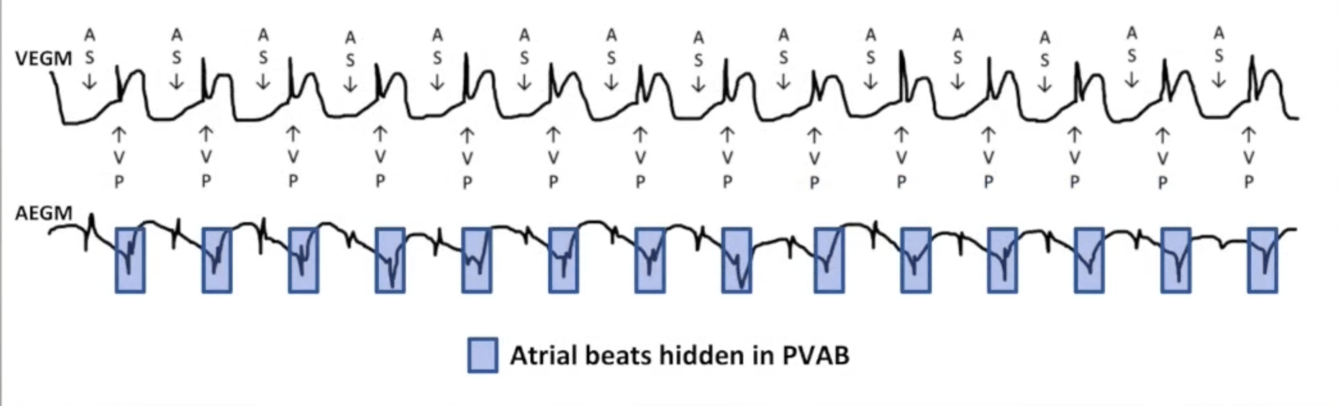 <ul><li><p>Atrial rate of 300 bpm</p></li><li><p>Every other beat in PVAB: no mode</p></li></ul><p></p>