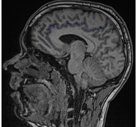 <p>Name the sulcus highlighted in blue, and the modality and plane</p>