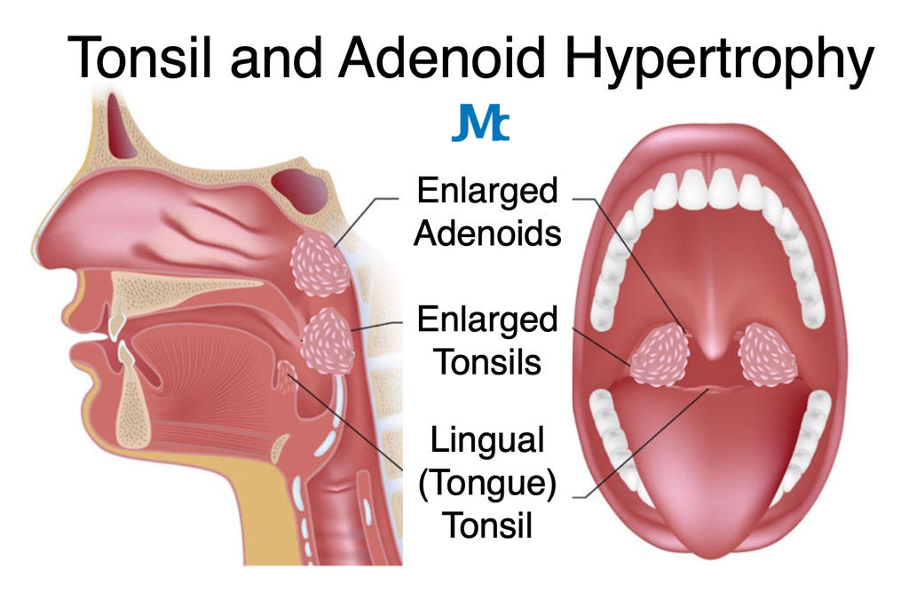 <p><strong>lymphoid</strong> tissue</p><p>plays important role in <strong>first line of defense</strong> efforts of immune systems</p><ul><li><p>tonsils removed when bacteria accumulates</p></li></ul><p></p>
