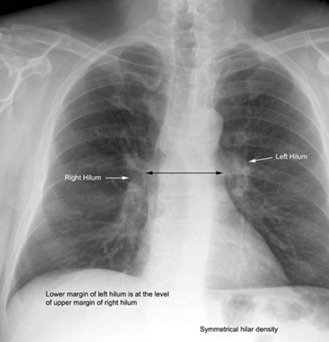 <p>depression in an organ where blood vessels and nerves enter and leave</p>