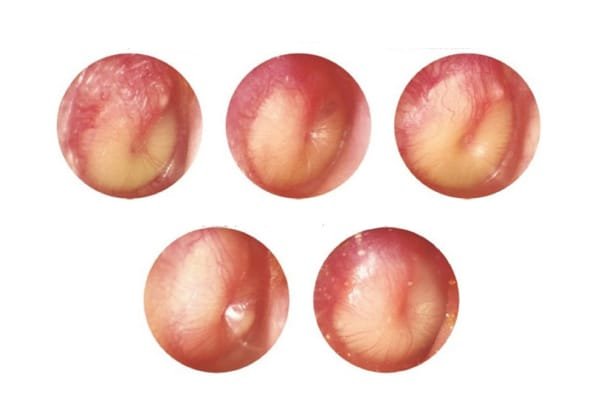 <p>PP: bx infxn of ME</p><p>E: H influenzae<br>s pneumoniae</p><p>CM: earache<br>fever<br>hearing loss</p><p>DX: <strong>bulging TM</strong><br><strong>loss of landmarks</strong></p>