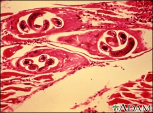 <p>Trichinosis</p>